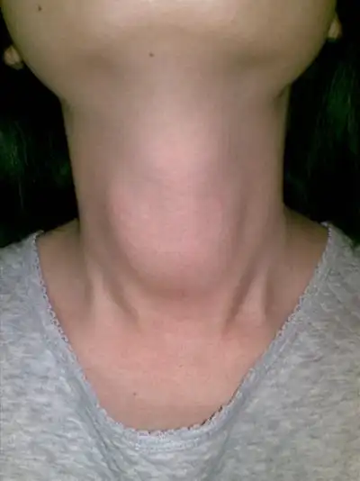 淋巴结肿大图片_淋巴结肿大症状表现图片大全_有来医生