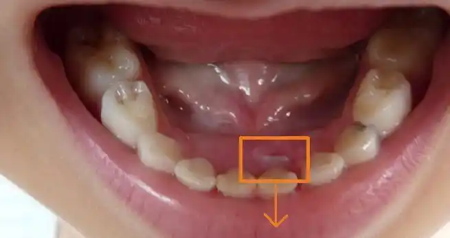 6岁男娃长出"双排牙",无奈拔掉乳牙,医生表示和日常饮食有关