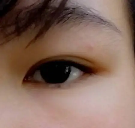 2014-02-02 唐荔霞 护师 我的下眼睑有—颗很小的黑痣,在我很小的