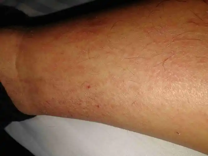 小腿痒抓后皮肤变红且很粗糙,红色的是疙瘩状的