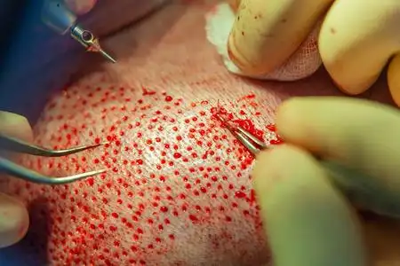 将毛囊从头部的一部分移走的外科技术.照片