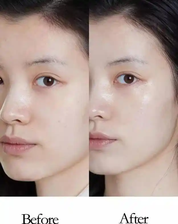 水光针适合所有人吗?一次能维持多久?术后该怎么护理?