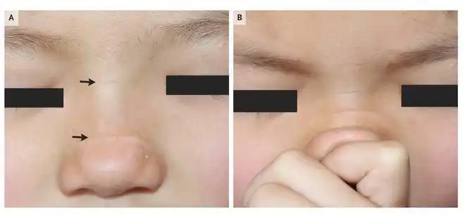 小女孩鼻上长横纹竟是因为这个习惯北京儿童医院nejm发表病例