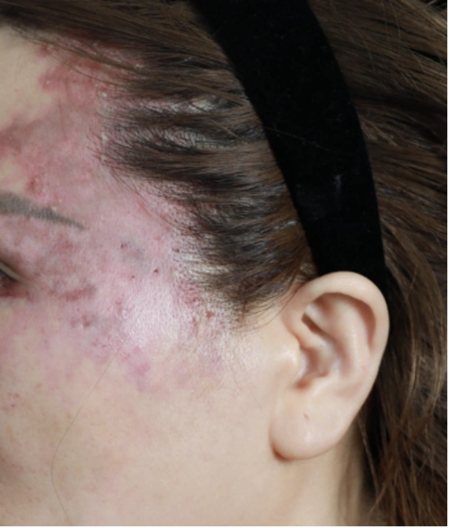 接受了眼眶部位的自体脂肪填充,结果眼周的皮肤变色坏死,视力也越来越