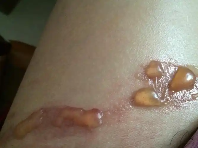 今天早上开水烫伤,位置在靠近大腿根部,抹了烫伤膏,起了水泡.