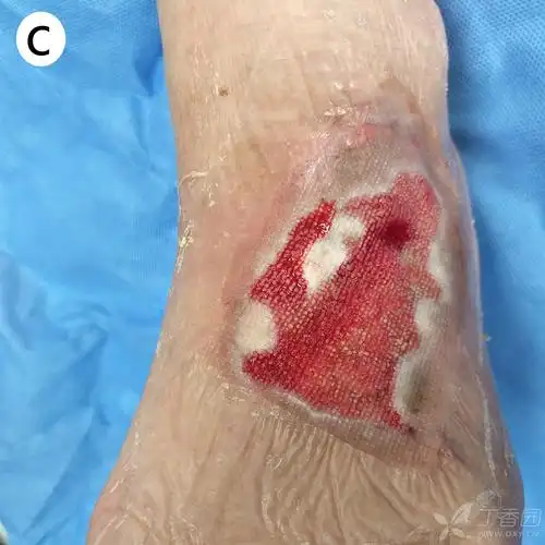 伤口护理专题:足背外伤后皮肤缺损处理经验分享