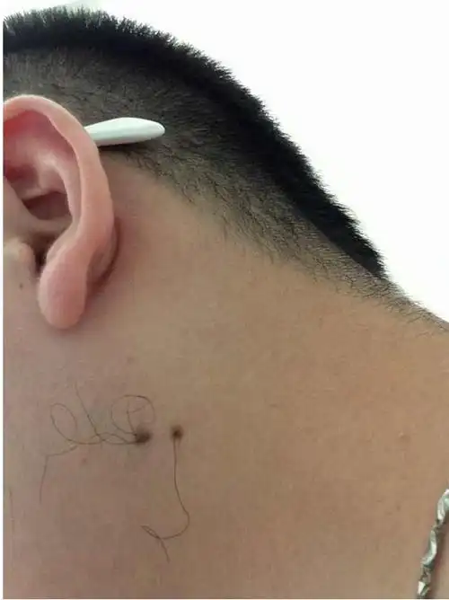 痣上长毛好不好痣上长毛经常自己拔了这回是怎