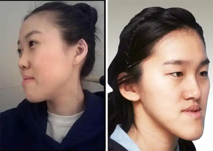 下巴长得不好看,以下五种人适合做下巴整形