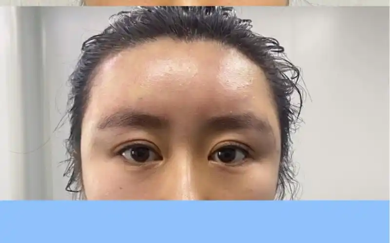 额头脂肪填充对比树前情况:额头骨性明显,凹凸不平.