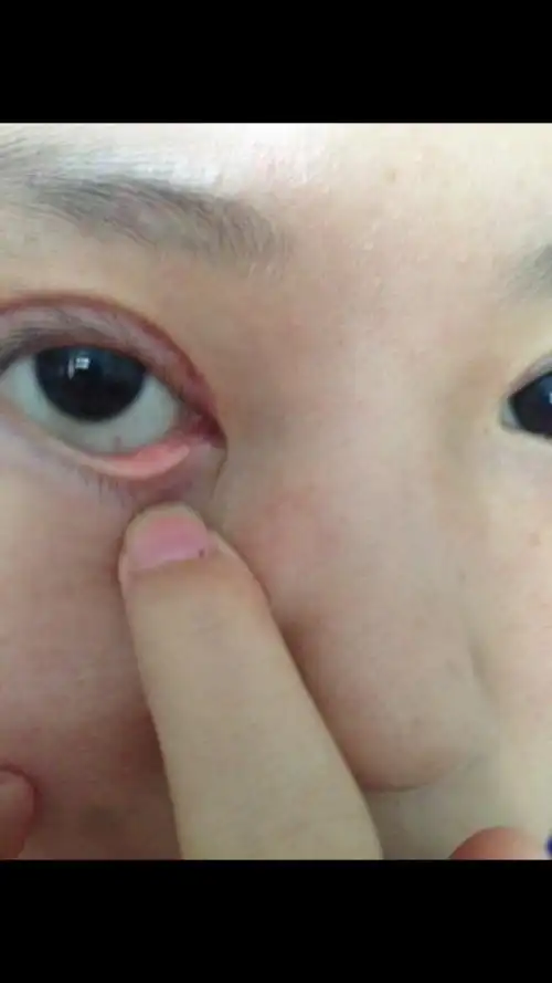 下眼睑有个小溃疡似的东西,以前没有,今天突然发现的,只有左眼有.
