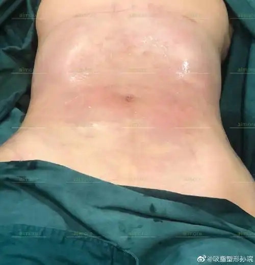 腰腹环吸##黄金微雕