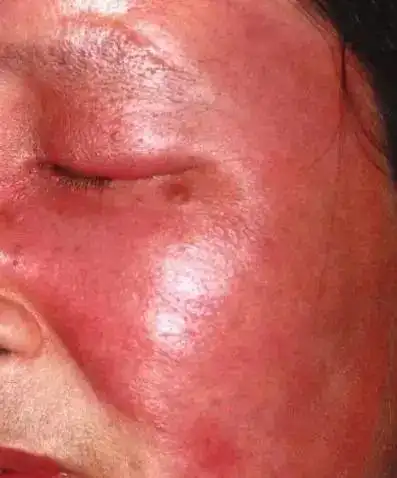 面部发红,可不单单是敏感肌