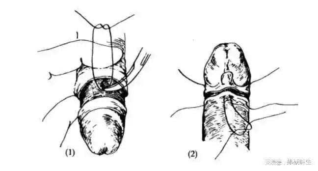 手术|吻合器|出血|炎症_网易订阅