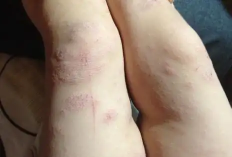 干性湿疹用什么药好?肤一清如何?