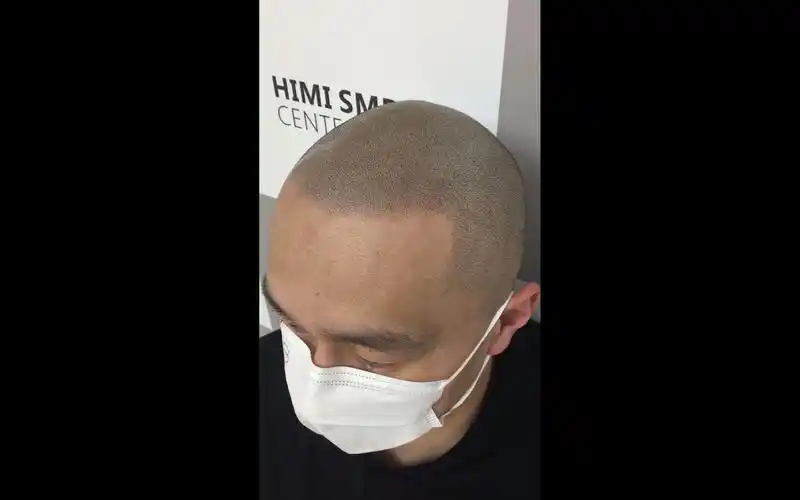 这种带斑白的脱发情况,美式型男寸头改造