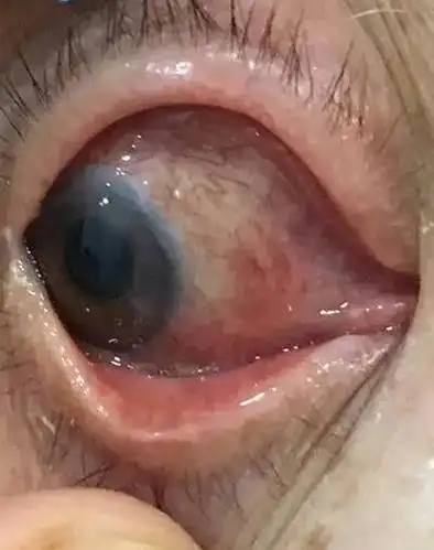 六旬老太复杂翼状胬肉 在成都华厦眼科医院 手术_常见眼病新闻