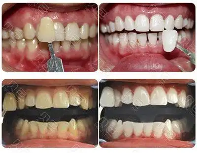 牙齿美白前后对比