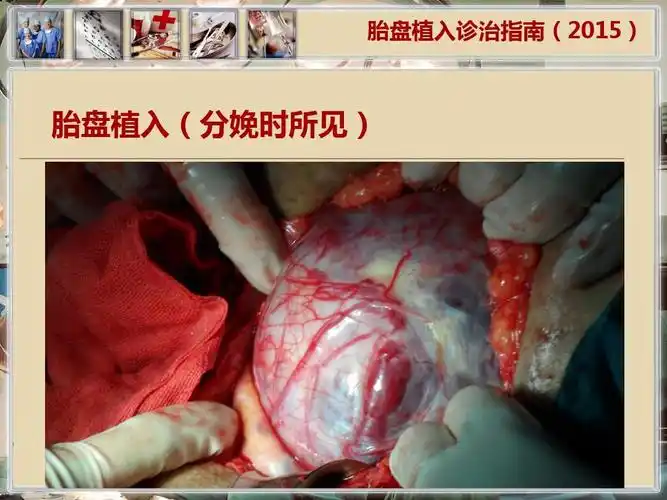 中华医学会《胎盘植入诊治指南2015》2010版ppt