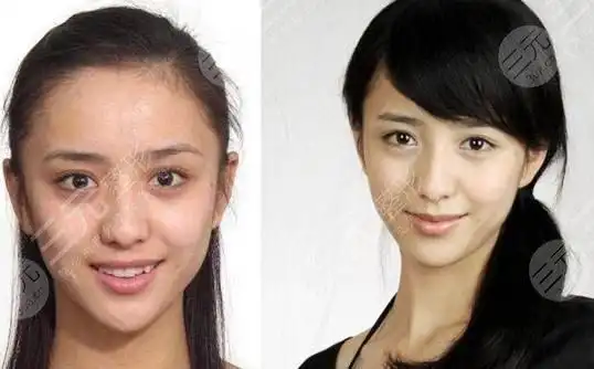 佟丽娅微整容前后照片对比丫丫整容了吗真相揭秘