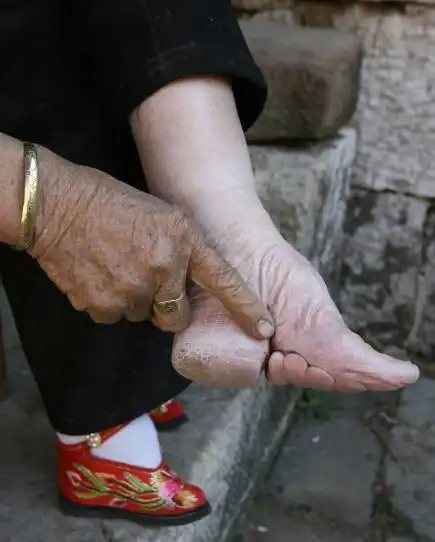 始于北宋的妇女缠足