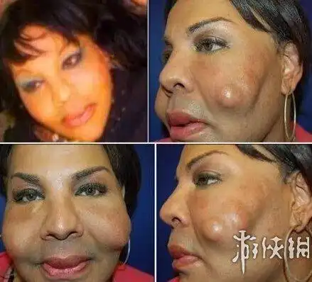 请慎点,全球最可怕的整形失败案例,真是太吓人了!