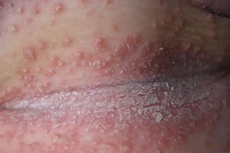 成功率高!念珠菌感染症状女性用什么"七星高照"-第1张图片-若克网