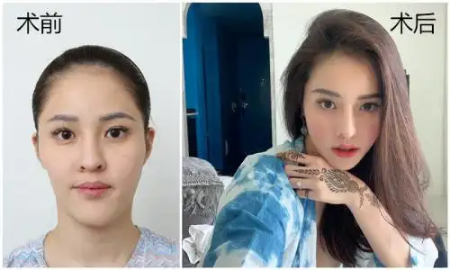 韩国长脸整容哪家医院效果更自然?必妩医院专利技术了解一下