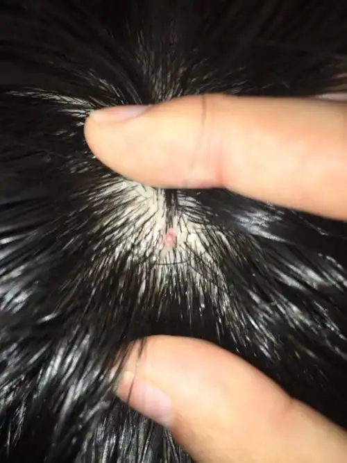 头皮上长了一个小疙瘩.这个是什么原因啊,会是癌症的潜在吗