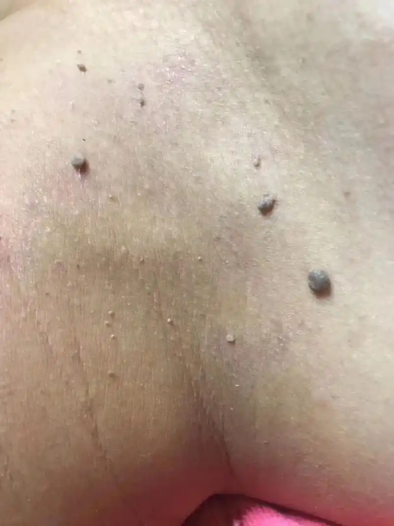 脖子上的"小肉揪"别忽视 疣,别抠,越抠越多01  一个传染 - 抖音