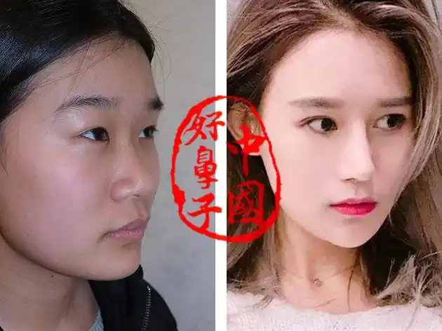 一个塌鼻子星人怎么才能变一个高鼻梁美人