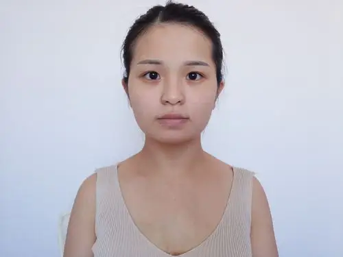 自体脂肪填充苹果肌