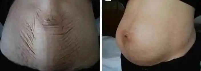 产后腹部膨出松弛怎么减都下不去怎么办