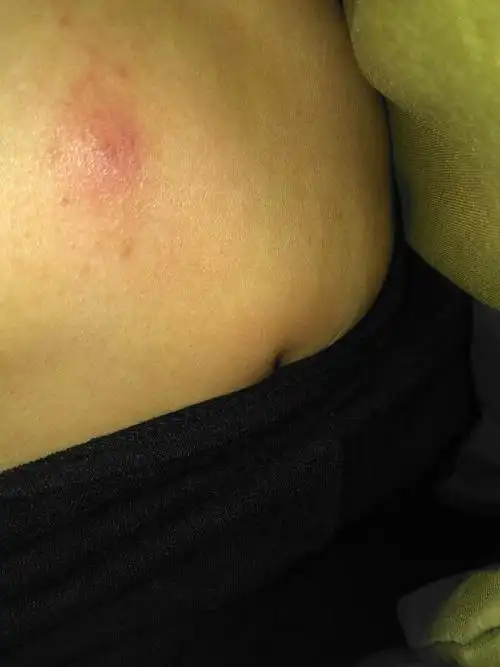 早晨起床突然有的,发现就这么大医生说是毛囊炎我就感觉不像.