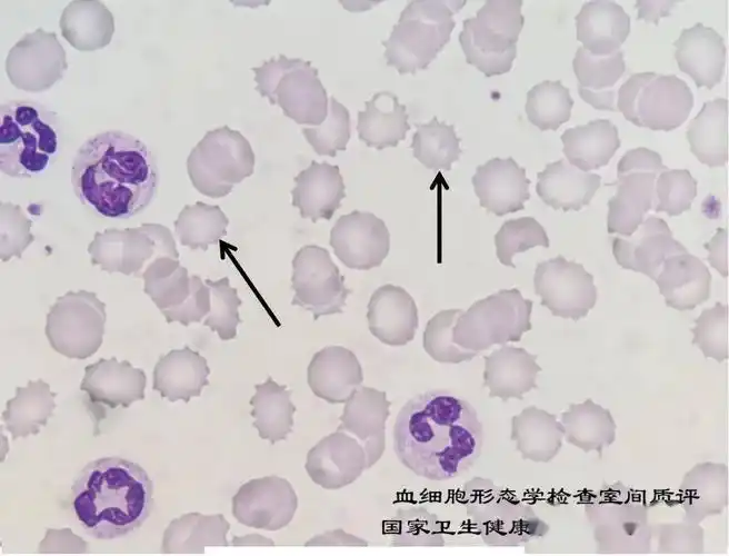 点击空白处查看答案钝锯齿形(皱缩)红细胞外周血涂片,瑞氏-吉姆萨染色