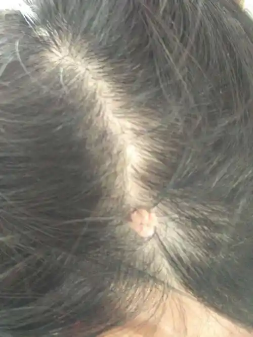 头皮上长的好像肉瘤一样的东西 十多年了 最初用手摸浅浅的 随