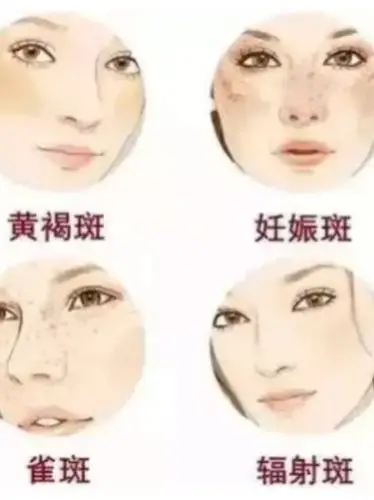 斑点也是有规律的不同部位的斑可能是不一样的