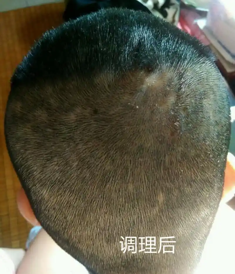 小伙头上毛囊炎脓包伴脱发,中医助力恢复如初!