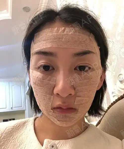 自体脂肪填充全脸