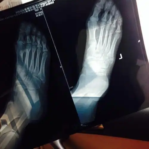 左脚第五跖骨基底部骨折 六月22号骨折.