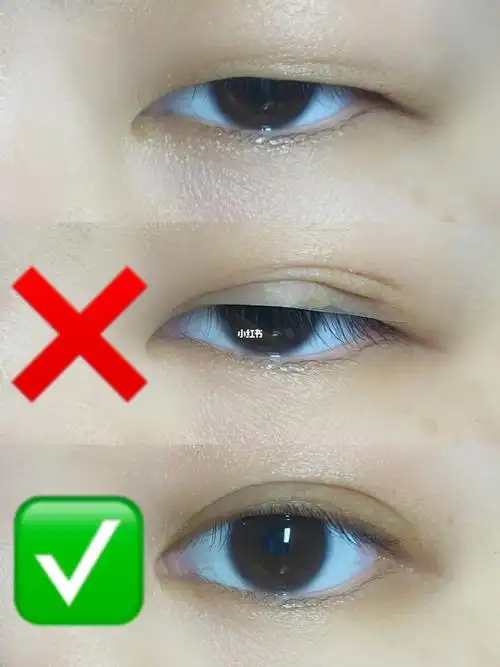 贴双眼皮很难吗单眼皮肿眼泡