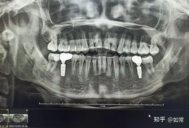 调合,接着戴右边,不知道为什么,右边一点也不疼,医生以为是种植体出