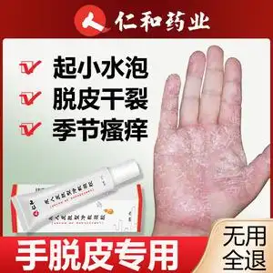 手脱皮手足藓真菌感染脚手上干裂水泡蜕皮专用手痒手气鹅掌风药膏