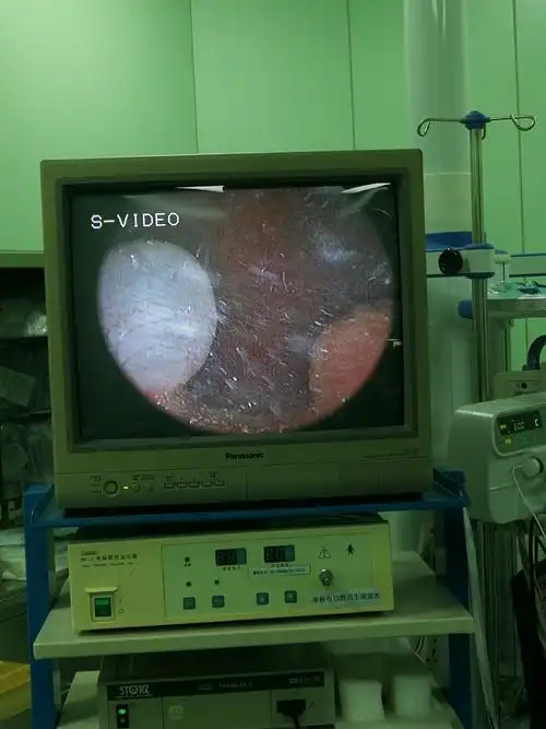 泗泾医院泌尿外科开展膀胱镜下钬激光治疗膀胱结石,无创伤,疗效肯定