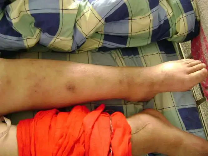 大家谁见过橡皮腿丝虫病这个像不像我没见过