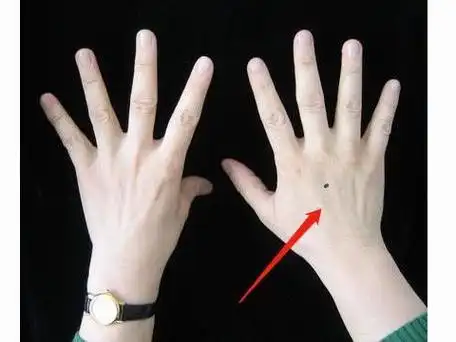 手背长痣图解分析