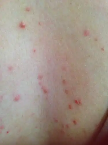 女28未婚,上个星期胸口乳沟正中长了四颗红色点点,有点像痘痘,但又痛