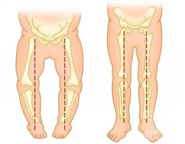 宝宝走路内八字外八字怎么办有纠正的方法吗