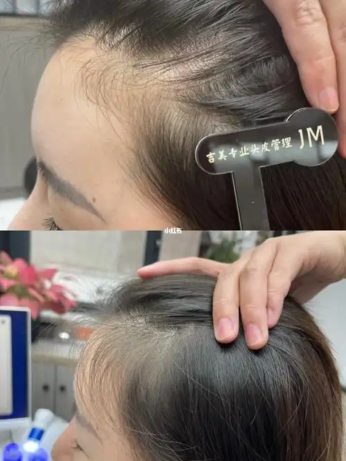 发际线生发对比