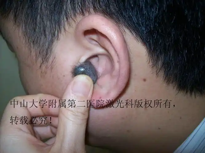 我用激光做的耳屏黑毛痣,手艺还不错吧! - 好大夫在线