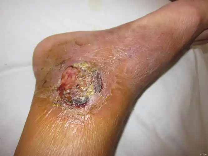 【求助】不明原因右下肢内踝部溃疡 - 骨科专业讨论版 -丁香园论坛